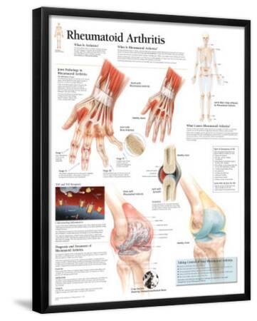 'Rheumatoid Arthritis Educational Chart Poster' Print | AllPosters.com