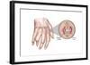 Rheumatoid Arthritis-Spencer Sutton-Framed Art Print