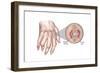 Rheumatoid Arthritis-Spencer Sutton-Framed Art Print