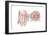 Rheumatoid Arthritis-Spencer Sutton-Framed Art Print