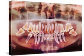 Root-canal Treatment, Dental X-ray-Science Photo Library-Stretched Canvas