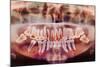 Root-canal Treatment, Dental X-ray-Science Photo Library-Mounted Premium Photographic Print