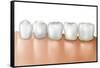 Row of Teeth Showing Gingivitis-null-Framed Stretched Canvas