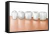Row of Teeth Showing Gingivitis-null-Framed Stretched Canvas