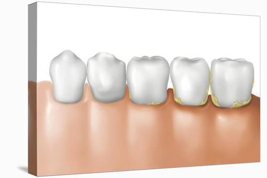 Row of Teeth Showing Gingivitis-null-Stretched Canvas