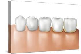 Row of Teeth Showing Gingivitis-null-Stretched Canvas