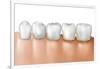 Row of Teeth Showing Gingivitis-null-Framed Art Print