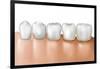 Row of Teeth Showing Gingivitis-null-Framed Art Print