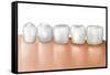 Row of Teeth Showing Gingivitis-null-Framed Stretched Canvas