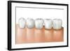 Row of Teeth Showing Gingivitis-null-Framed Art Print