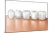 Row of Teeth Showing Gingivitis-null-Mounted Art Print