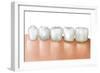 Row of Teeth Showing Gingivitis-null-Framed Art Print