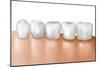 Row of Teeth Showing Gingivitis-null-Mounted Art Print