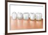 Row of Teeth Showing Gingivitis-null-Framed Art Print