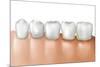 Row of Teeth Showing Gingivitis-null-Mounted Art Print