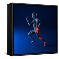 Running Injuries, Conceptual Artwork-SCIEPRO-Framed Stretched Canvas