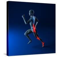 Running Injuries, Conceptual Artwork-SCIEPRO-Stretched Canvas