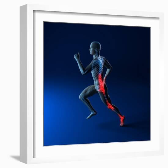 Running Injuries, Conceptual Artwork-SCIEPRO-Framed Premium Photographic Print
