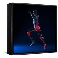 Running Injuries, Conceptual Artwork-SCIEPRO-Framed Stretched Canvas