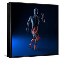 Running Injuries, Conceptual Artwork-SCIEPRO-Framed Stretched Canvas