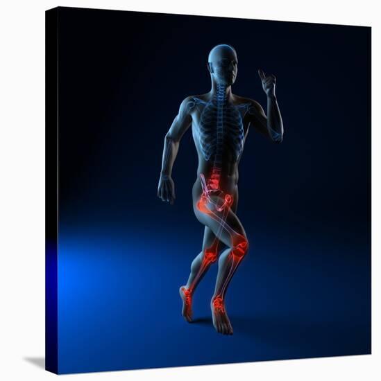 Running Injuries, Conceptual Artwork-SCIEPRO-Stretched Canvas