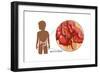 Ruptured Appendix-Monica Schroeder-Framed Art Print