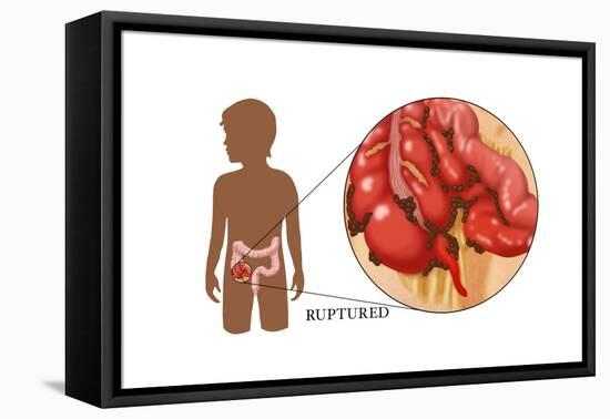 Ruptured Appendix-Monica Schroeder-Framed Stretched Canvas