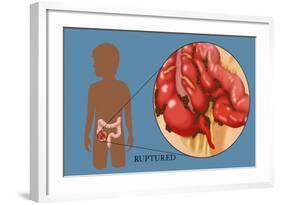 Ruptured Appendix-Monica Schroeder-Framed Giclee Print