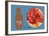 Ruptured Appendix-Monica Schroeder-Framed Giclee Print