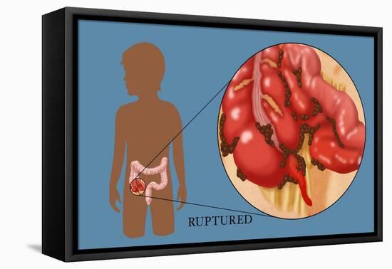 Ruptured Appendix-Monica Schroeder-Framed Stretched Canvas