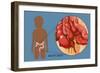 Ruptured Appendix-Monica Schroeder-Framed Giclee Print