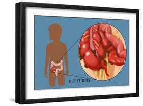Ruptured Appendix-Monica Schroeder-Framed Giclee Print