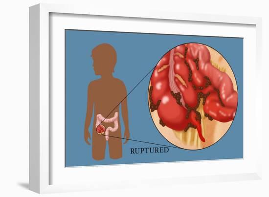 Ruptured Appendix-Monica Schroeder-Framed Giclee Print