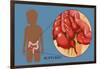 Ruptured Appendix-Monica Schroeder-Framed Giclee Print