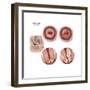 Sagittal View and Vaginal View of Advanced Cervical Cancer-null-Framed Premium Giclee Print