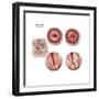 Sagittal View and Vaginal View of Advanced Cervical Cancer-null-Framed Premium Giclee Print