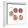 Sagittal View and Vaginal View of Advanced Cervical Cancer-null-Framed Premium Giclee Print