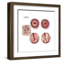 Sagittal View and Vaginal View of Advanced Cervical Cancer-null-Framed Art Print