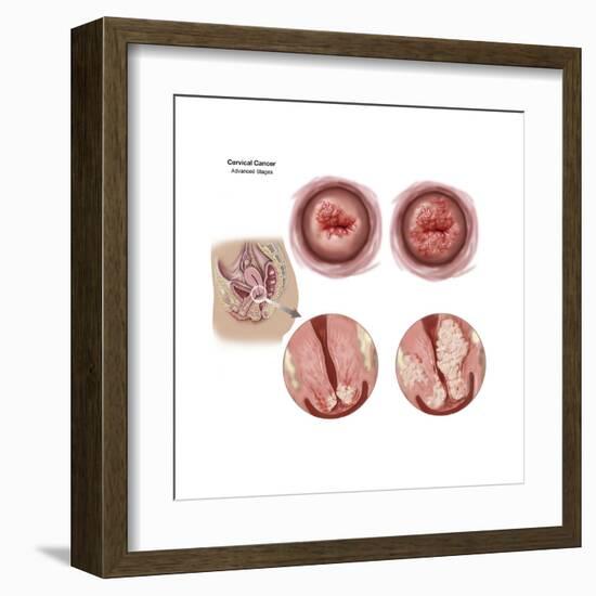 Sagittal View and Vaginal View of Advanced Cervical Cancer-null-Framed Art Print