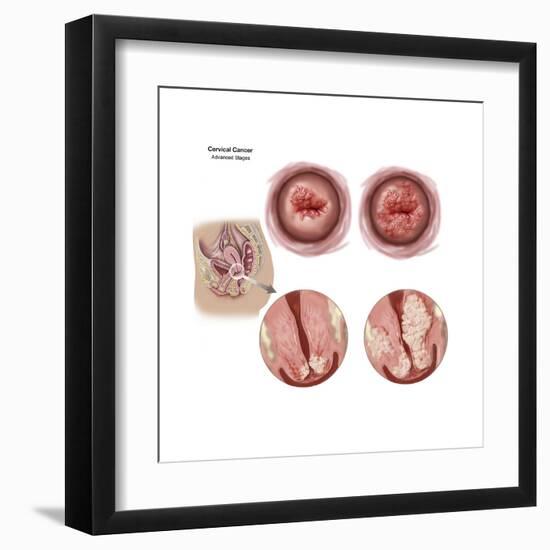 Sagittal View and Vaginal View of Advanced Cervical Cancer-null-Framed Art Print