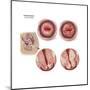 Sagittal View and Vaginal View of Advanced Cervical Cancer-null-Mounted Art Print