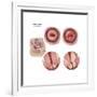Sagittal View and Vaginal View of Advanced Cervical Cancer-null-Framed Art Print