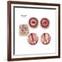 Sagittal View and Vaginal View of Advanced Cervical Cancer-null-Framed Art Print