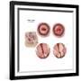 Sagittal View and Vaginal View of Advanced Cervical Cancer-null-Framed Art Print