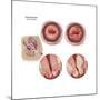 Sagittal View and Vaginal View of Advanced Cervical Cancer-null-Mounted Art Print