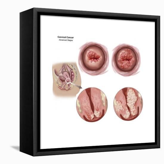 Sagittal View and Vaginal View of Advanced Cervical Cancer-null-Framed Stretched Canvas