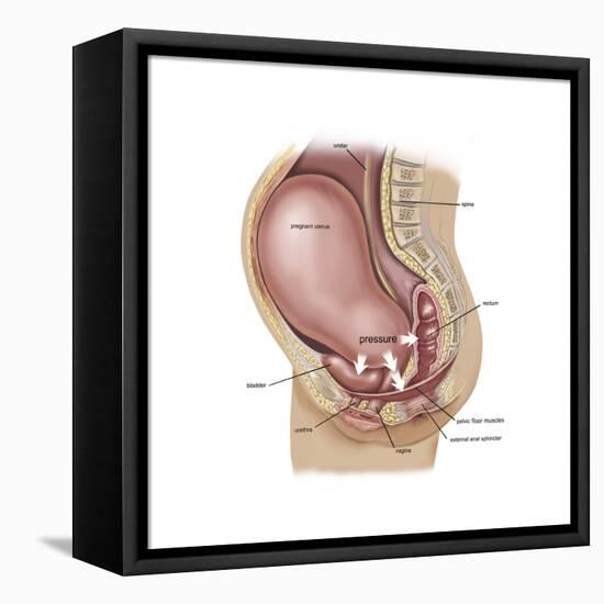 Sagittal View of Pregnant Uterus Showing Displaced Pelvic Organs-null-Framed Stretched Canvas