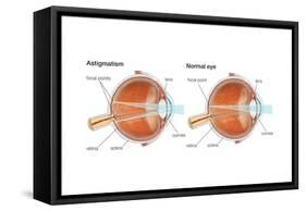 Scleral Buckle. Eye, Ophthalmology, Health and Disease-Encyclopaedia Britannica-Framed Stretched Canvas