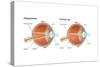 Scleral Buckle. Eye, Ophthalmology, Health and Disease-Encyclopaedia Britannica-Stretched Canvas