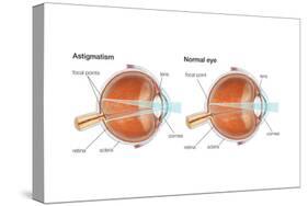 Scleral Buckle. Eye, Ophthalmology, Health and Disease-Encyclopaedia Britannica-Stretched Canvas